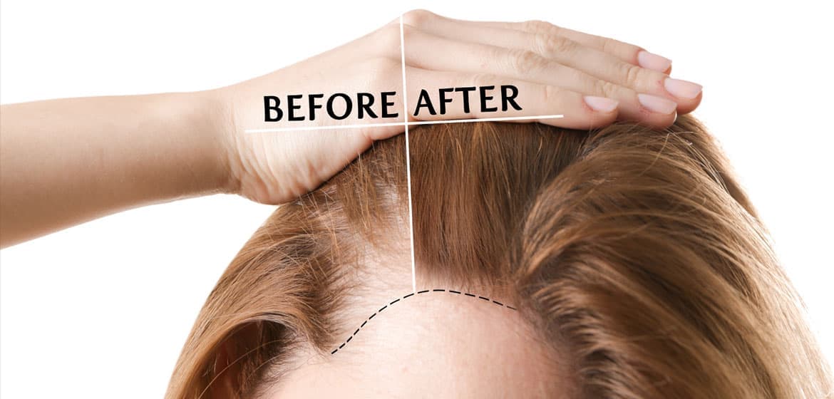 Hair Transplant Turkey: Step-by-Step Guide for First-Time Patients