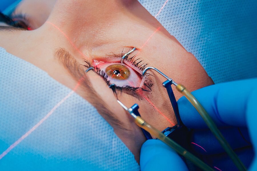 Understanding LASIK Turkey: Benefits, Procedures, and Costs